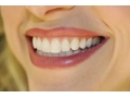 Top 9 thực phẩm làm trắng răng cực hiệu quả